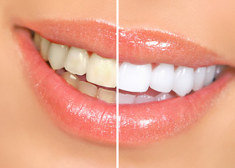 Teeth Whitening Procedure Explained